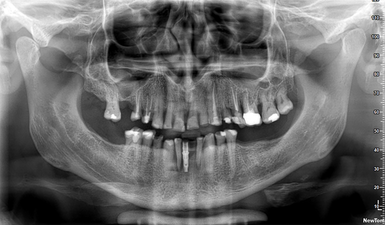 Panoramic dental radiograph