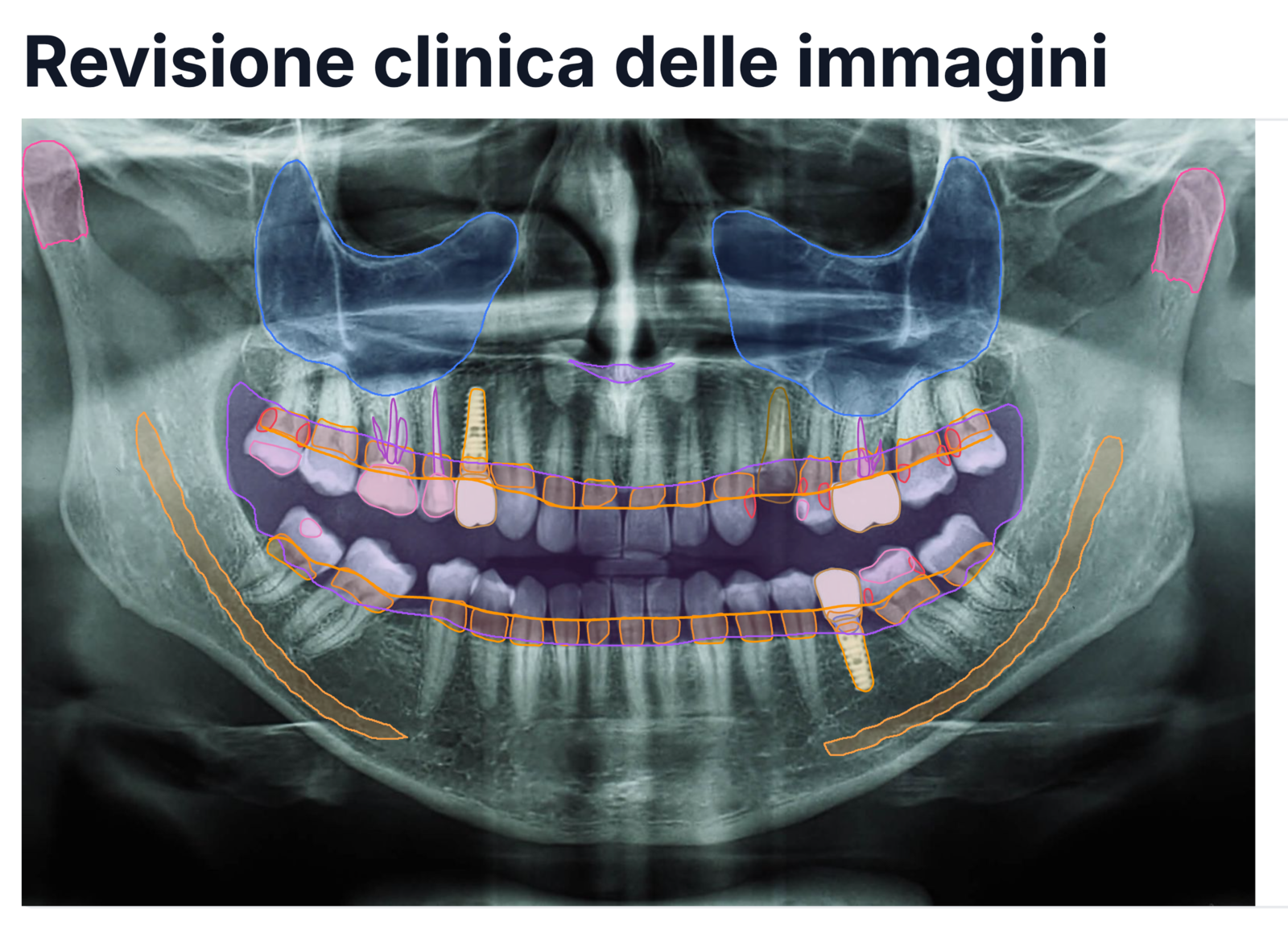 Real Vesalya Smart Report with an annotated panoramic radiograph